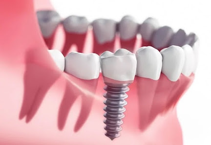 Albany Implants